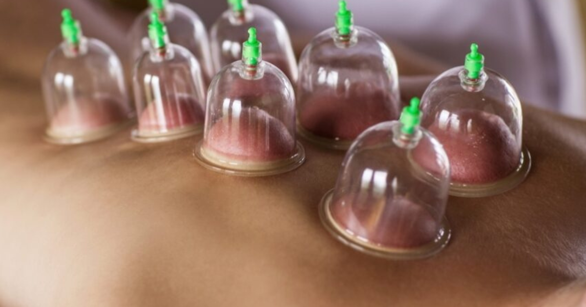 Cupping: een mooie toevoeging aan de behandeling - Alles over massage
